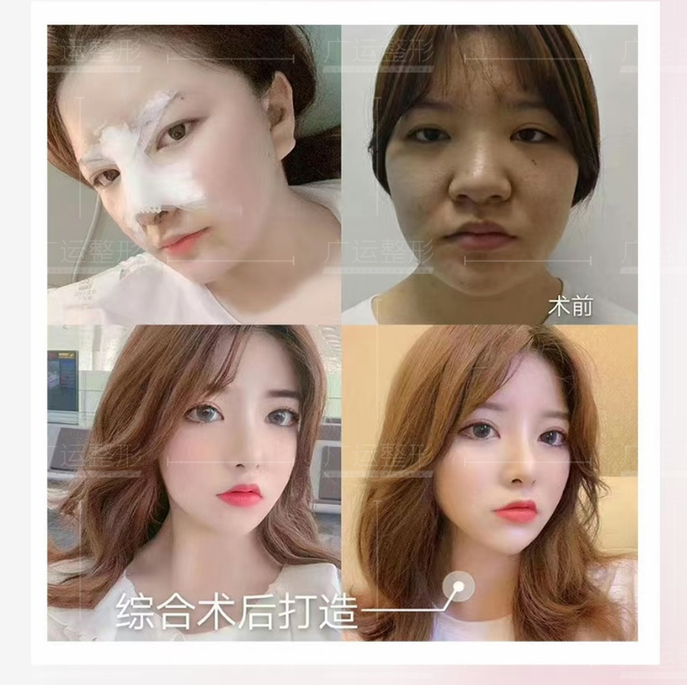 遂宁鹰钩鼻术对面部有什么影响_整形价格