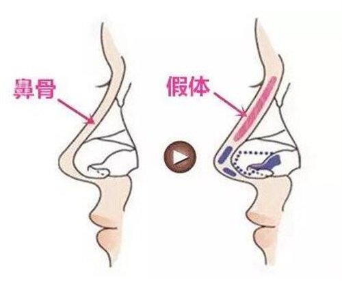 绥化韩式鼻翼缩小术后怎么避免后遗症_整形百科